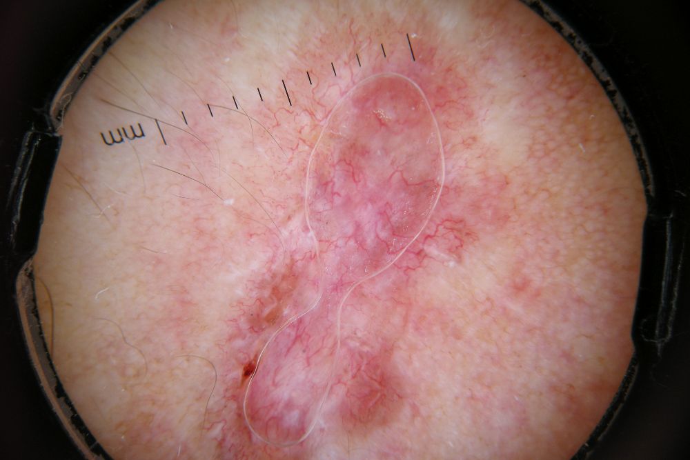 Fotografía cedida por el Instituto Politécnico Nacional de una muestra de piel afectada por cáncer.