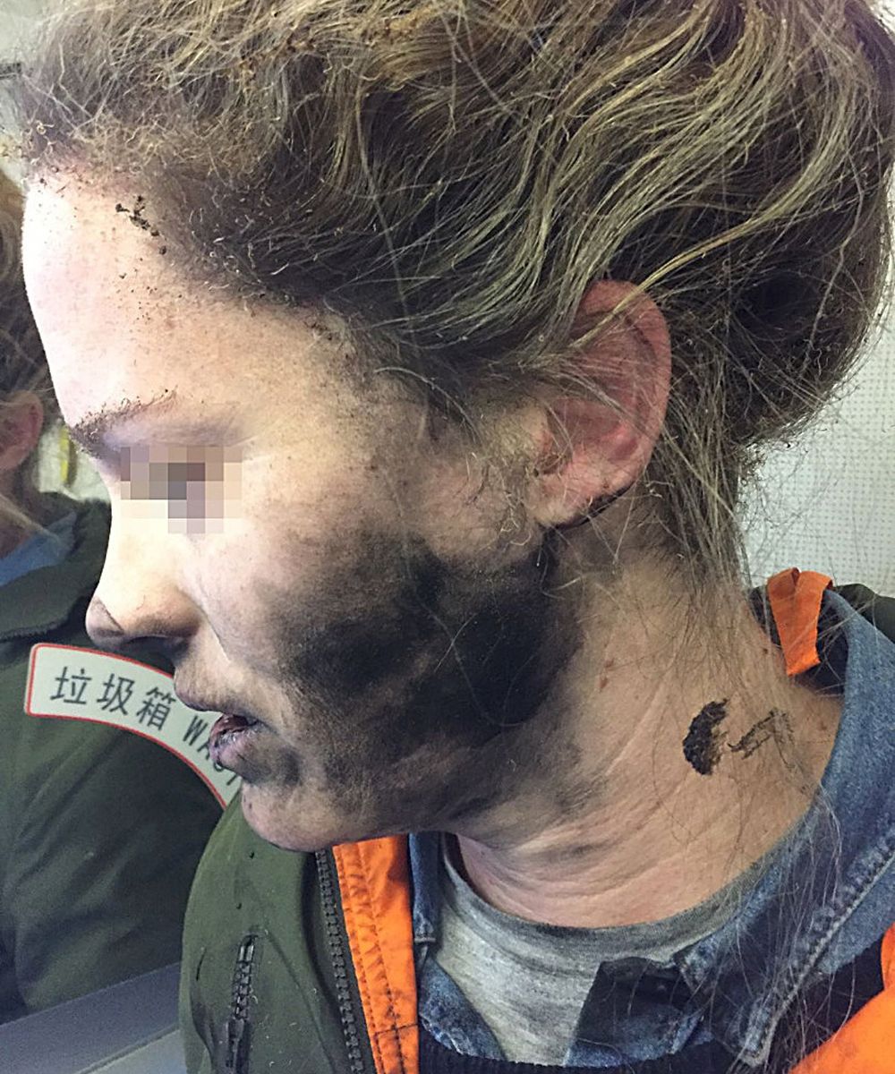 Así le quedó la cara a la mujer después de que los auriculares que llevaba explotaran durante un vuelo desde Pekín (China) a Melbourne (Australia). 
