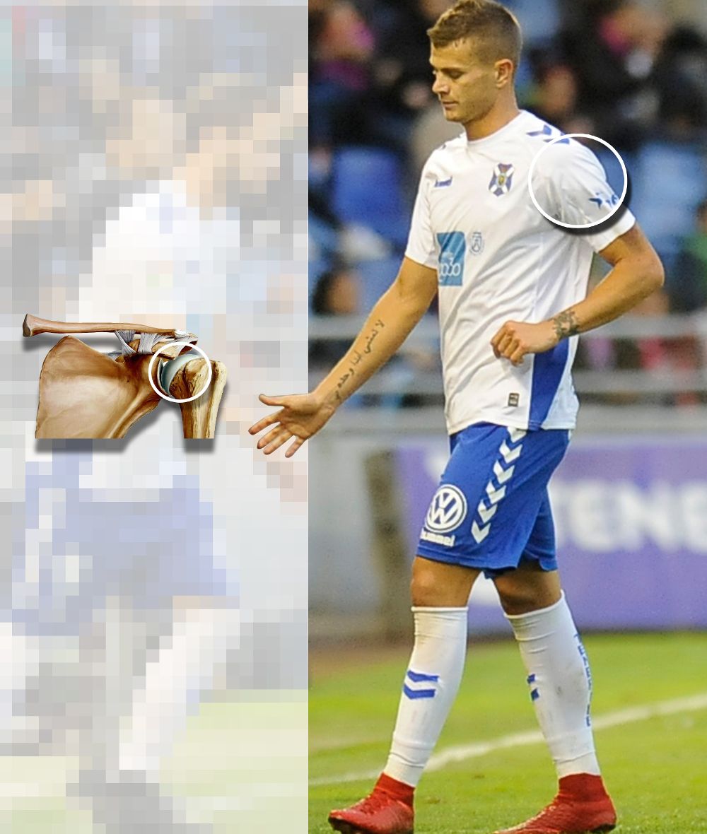 El jugador y, a la izquierda, el lugar exacto de la lesión, en el hombro izquierdo.