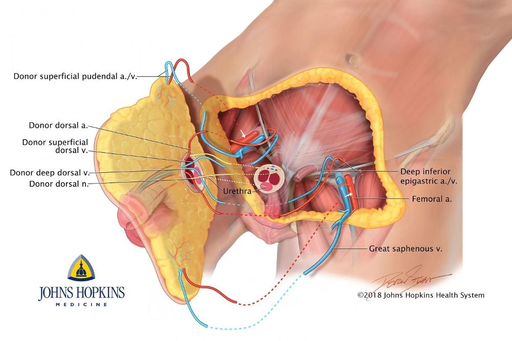 Diagrama del primer trasplante de pene y escroto en el mundo.