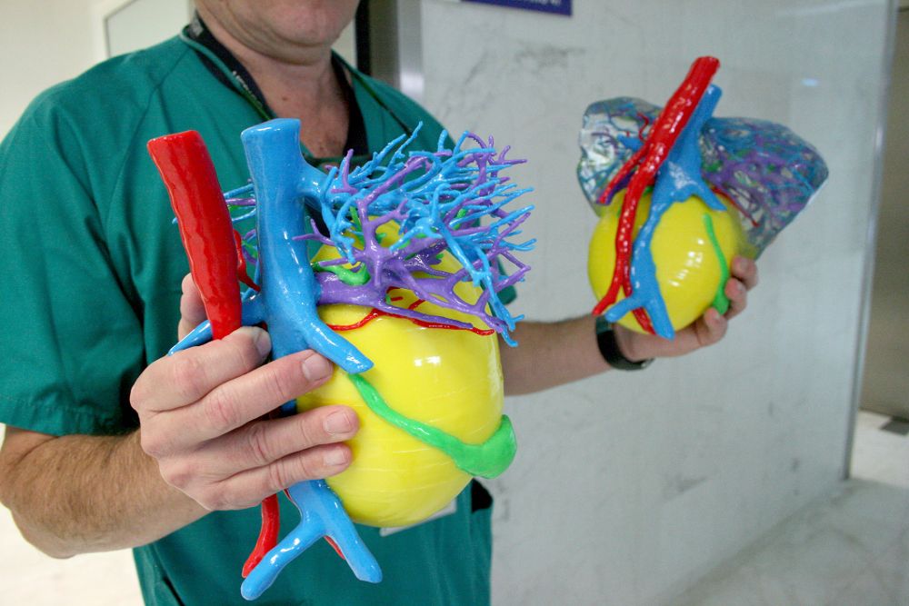 Modelos elaborados en 3D para abordar las cirugías hepáticas más complejas en el hospital de La Candelaria.