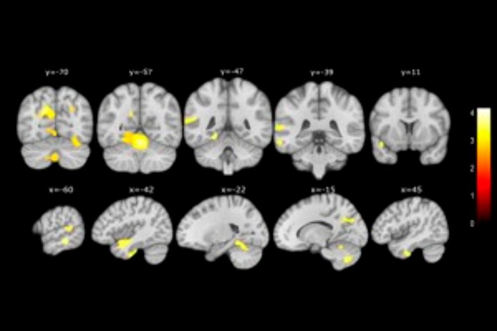 Cambios en el cerebro detectados por el estudio de la Fundación Pasqual Maragall que ayudará a acotar el riesgo de alzheimer.