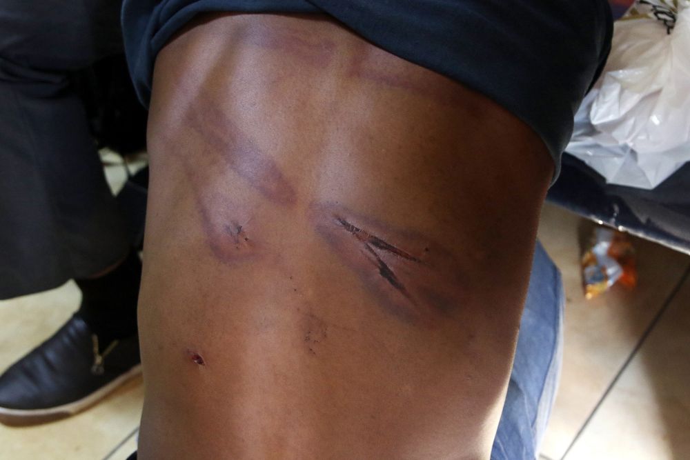 Una víctima de la represión policial muestra sus heridas.