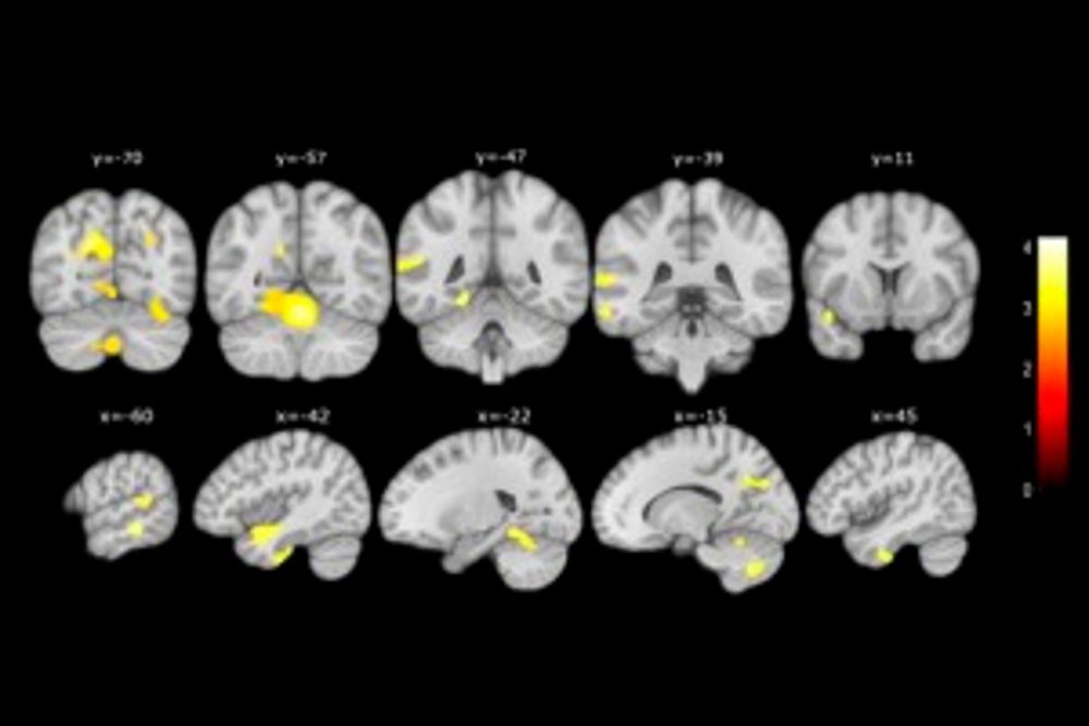 Cambios en el cerebro detectados por el estudio de la Fundación Pasqual Maragall.